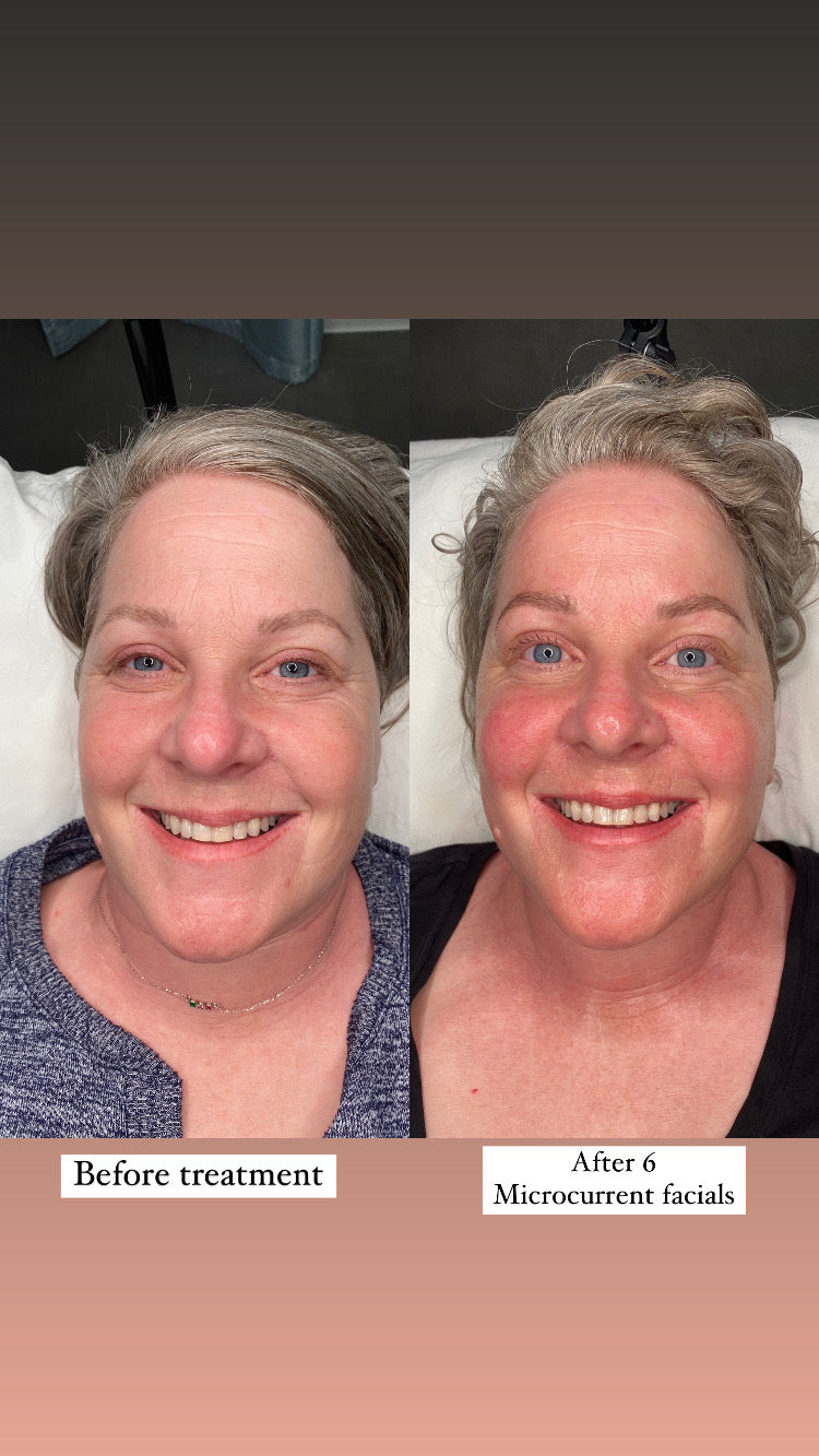 Microcurrent Facial Rejuvenation
