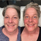 Microcurrent Facial Rejuvenation