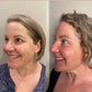 Microcurrent Facial Rejuvenation