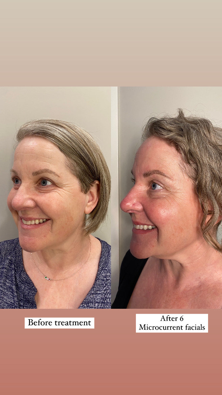 Microcurrent Facial Rejuvenation