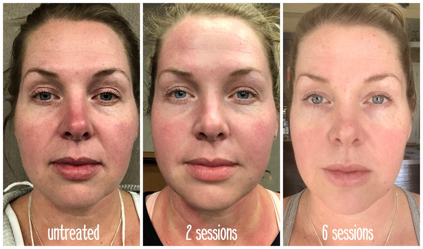 After 2 and 6 sessions! Notice the skin texture and tone, redness on nose is gone, eyes appear lifted. Colour of eyes even appear lightened. Grooves around mouth softened, hooding around eyes reduced. wrinkles on forehead reduced. Overall puffiness reduced.