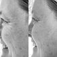 Microcurrent Facial Rejuvenation