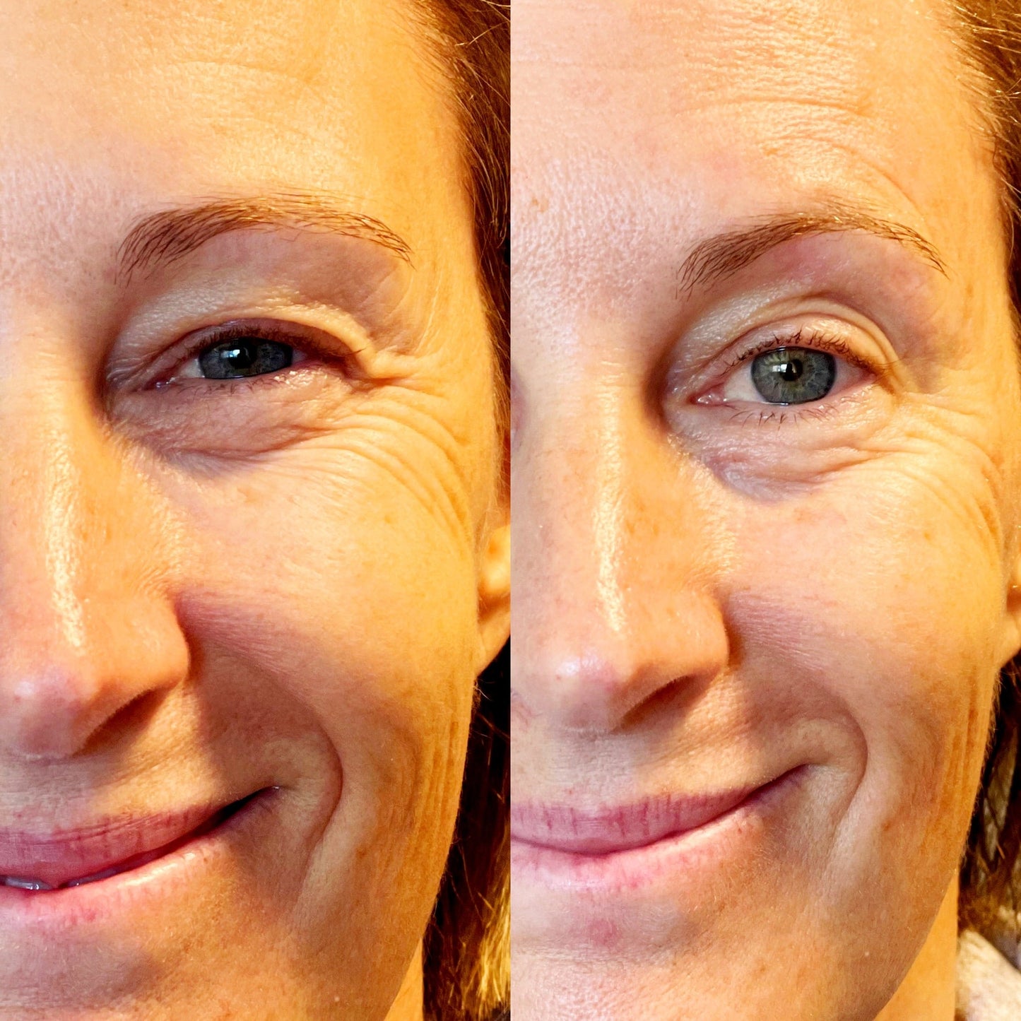 Microcurrent Facial Rejuvenation