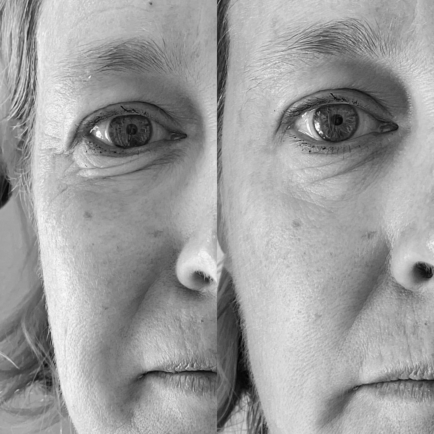 Microcurrent Facial Rejuvenation